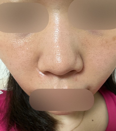 after photo: ハイドラフェイシャル