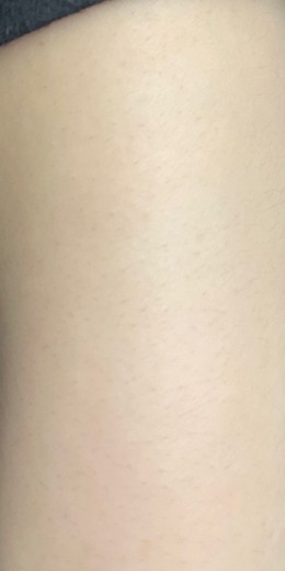 after photo: 팔제모, 종아리제모