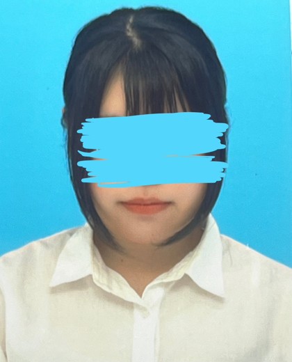 before photo: 脂肪吸引(顎下), 脂肪吸引(顔), 脂肪吸引(頬)