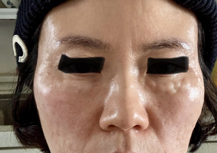 after photo: 리쥬란힐러