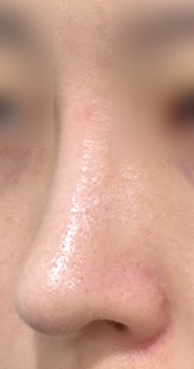 after photo: 콧대(보형물), 코끝(자가연골)