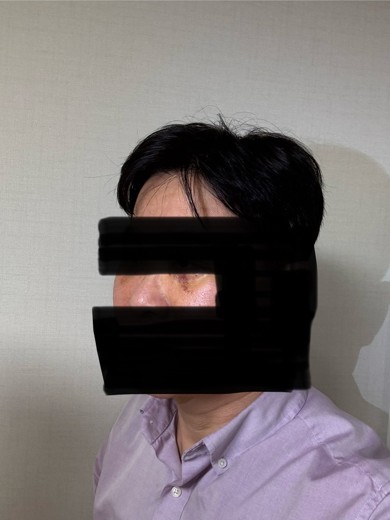 after photo: 눈밑지방재배치