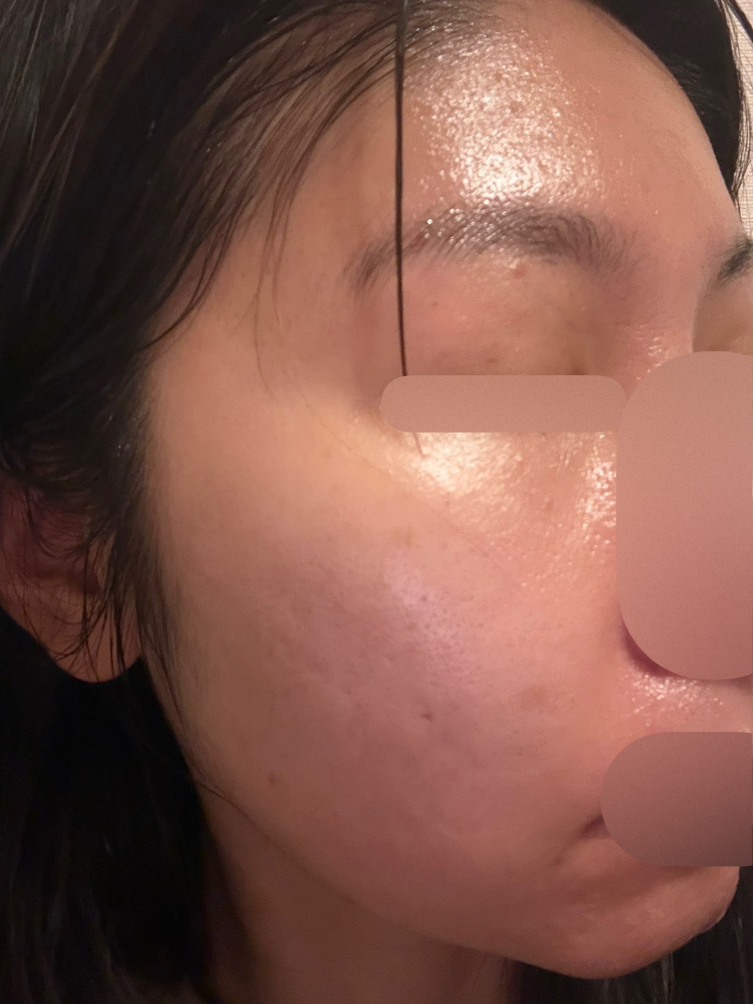 透明感・ハリ艶肌に！毛穴洗浄・導入施術』ハイドラジェントル＋8種の