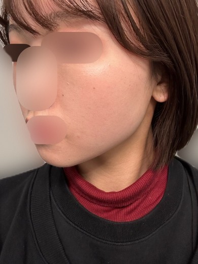 after photo: ビタミン注射・点滴