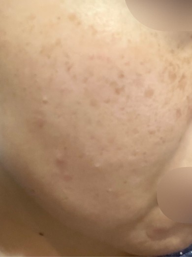 after photo: IPL(光/フォト治療)