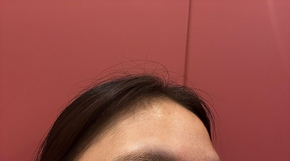 before photo: 이마필러