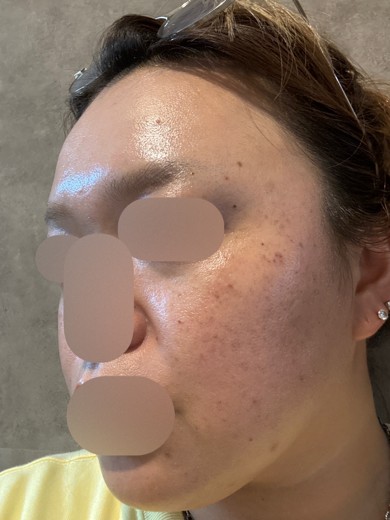 after photo: ルメッカ