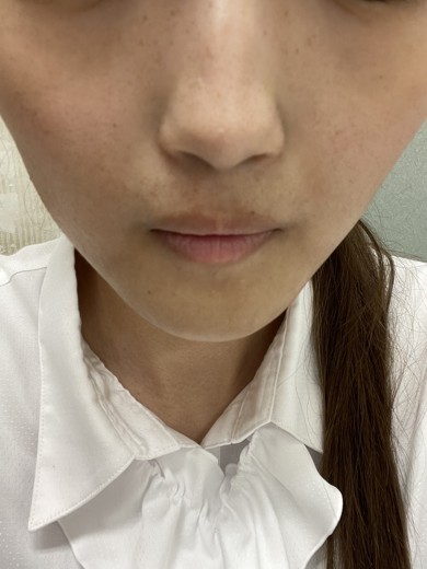 before photo: ピーリング, ルメッカ