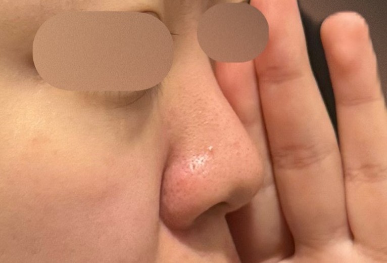 before photo: 콧대(보형물), 코끝(자가연골), 복코교정(수술)