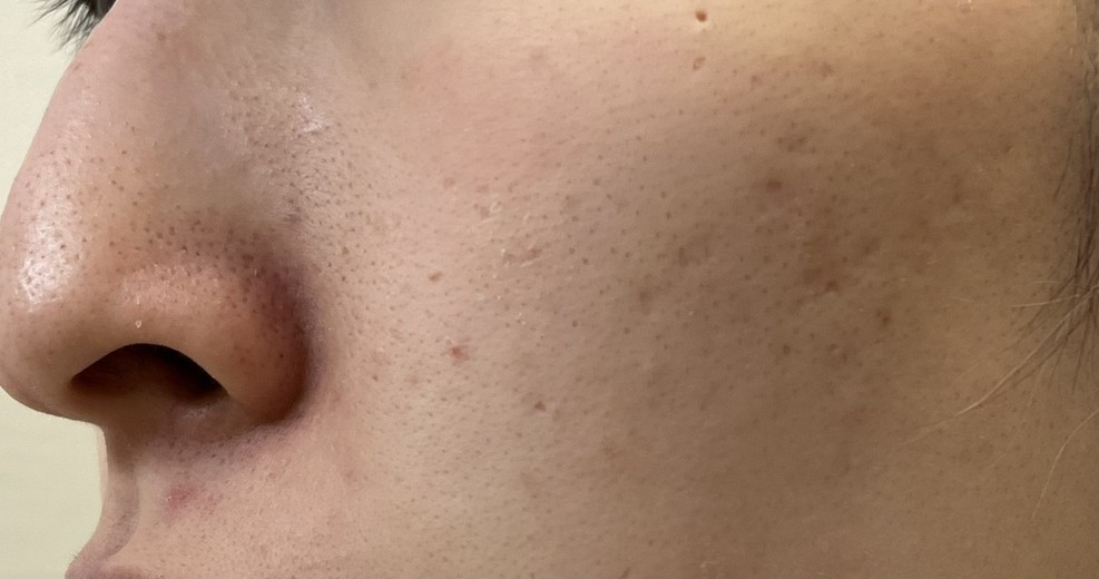 before photo: ダーマペン
