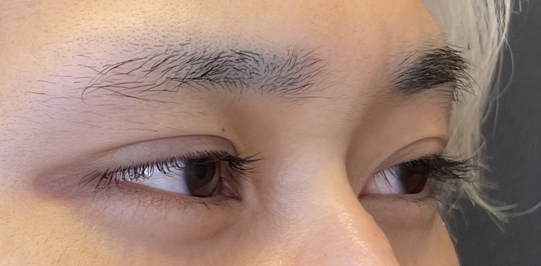 before photo: タレ目形成, 目尻切開