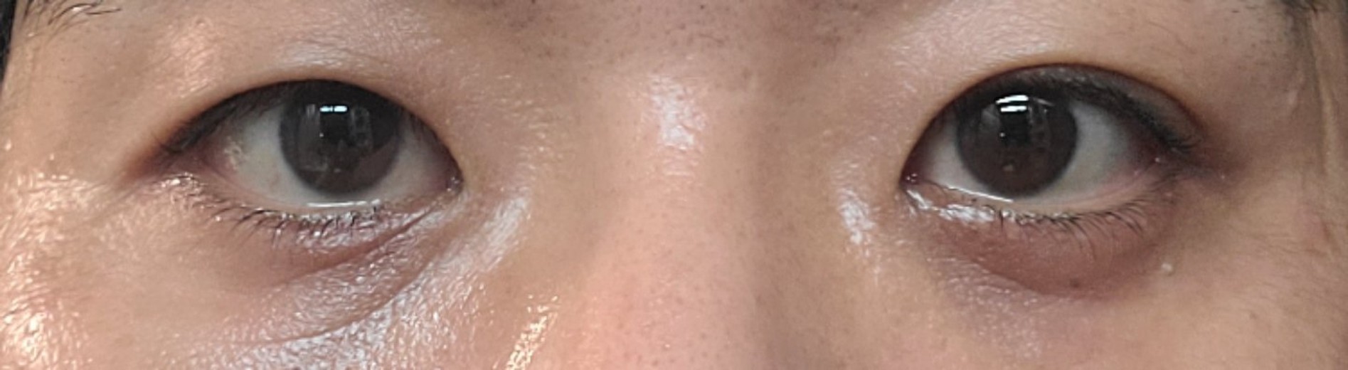 after photo: 눈밑지방재배치