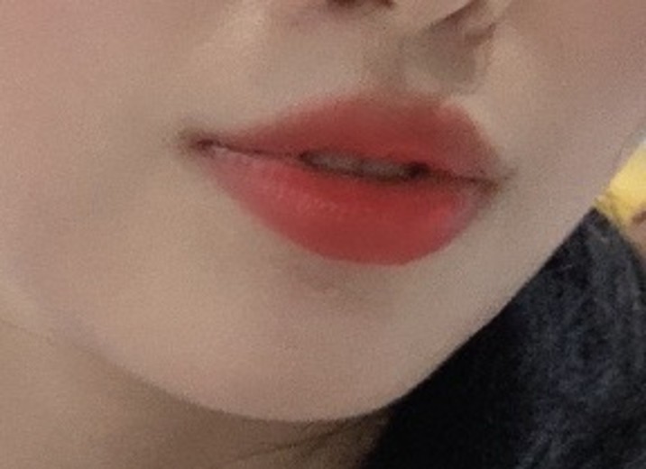 before photo: 입꼬리필러, 입술필러