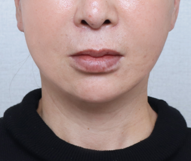 after photo: 실리프팅