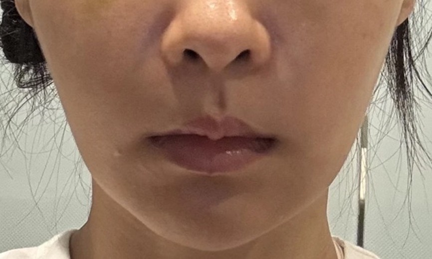 before photo: 입술필러