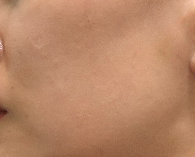 after photo: ピーリング, ルメッカ