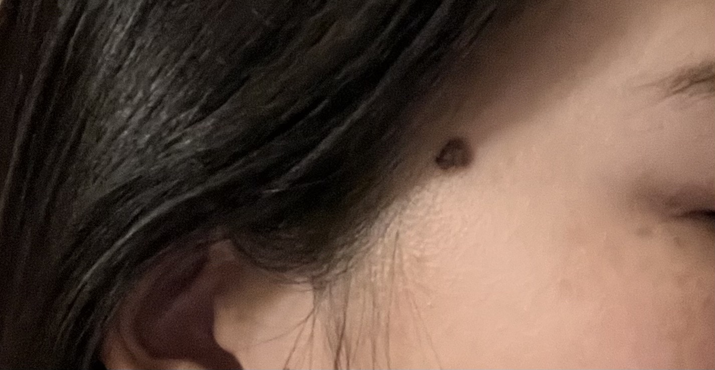 ホクロ・イボ除去｜顔2箇所／1箇所4mm未満 | ルラ美容クリニック沖縄院