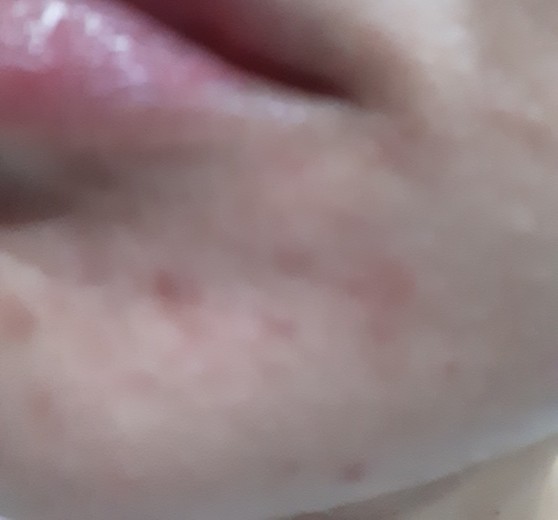 after photo: 여드름주사