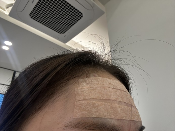 after photo: 이마필러