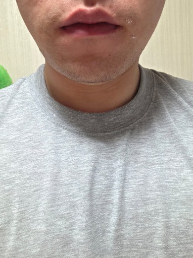 after photo: 아쿠아필링