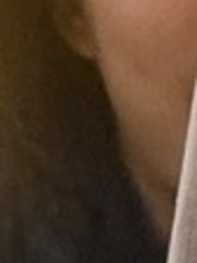 after photo: 사각턱보톡스