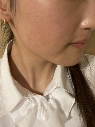 after photo: ピーリング, ルメッカ
