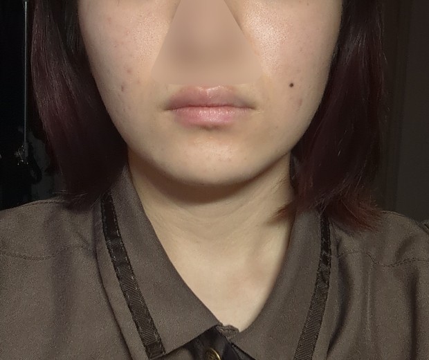 after photo: IPL(光/フォト治療), イオン導入