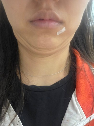 before photo: 침샘보톡스