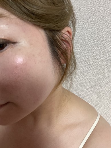 after photo: ダーマペン