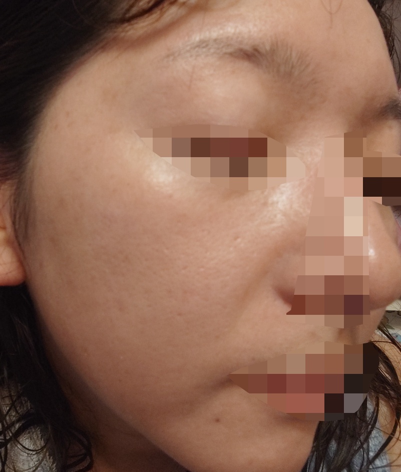 何度でも可】ピコトーニング「ピコウェイ（承認機）」｜全顔1回