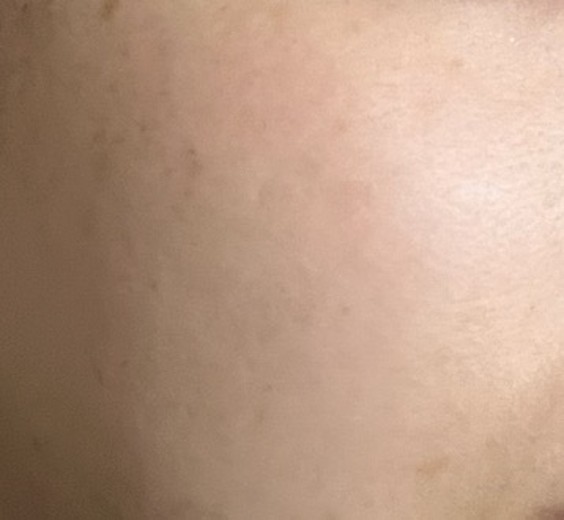 after photo: 白玉注射・点滴