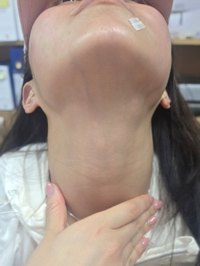 after photo: 침샘보톡스