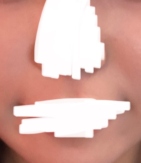 after photo: 팔자주름필러