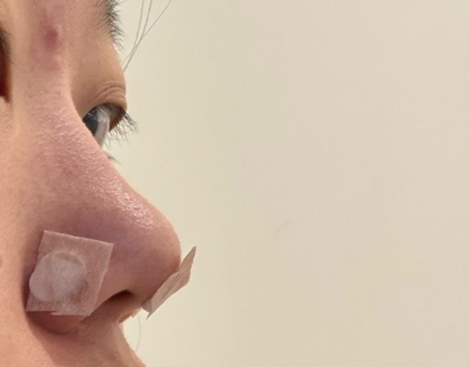 before photo: 코필러, 코프팅