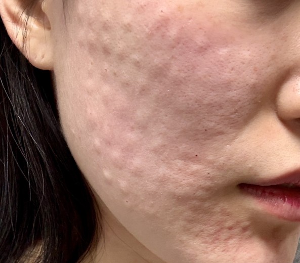 after photo: 리쥬란힐러