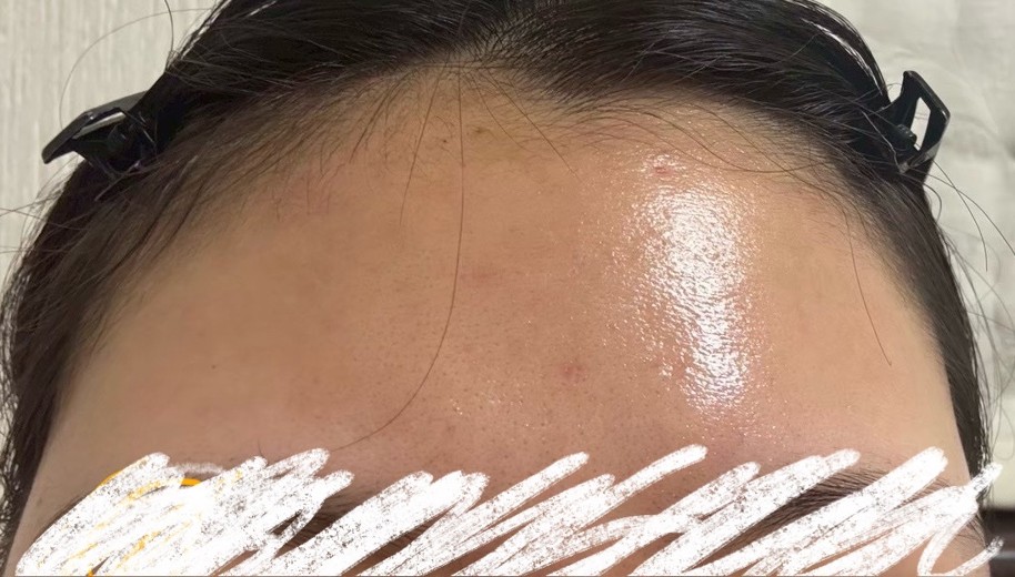 before photo: ダーマペン