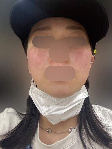 after photo: ララピール(LHAピーリング)