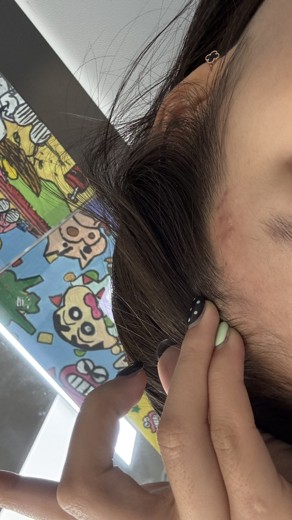 after photo: 아쿠아필링