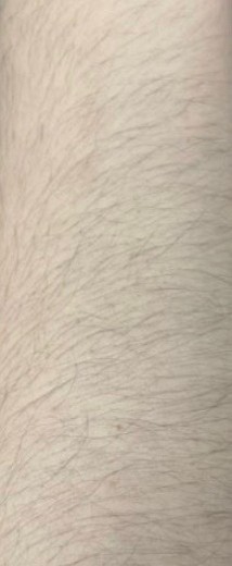 before photo: 팔제모, 종아리제모