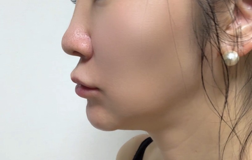 after photo: チタニウムリフト