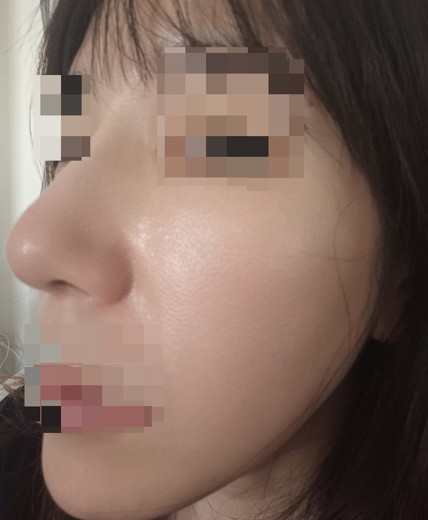 after photo: IPL(光/フォト治療), ピーリング, エレクトロポレーション