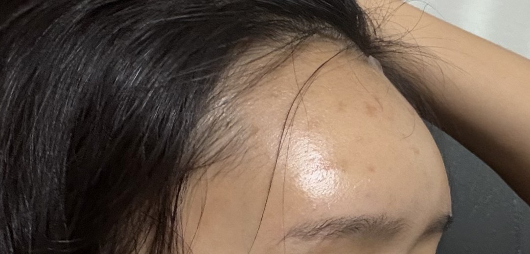 after photo: 이마필러, 관자놀이필러