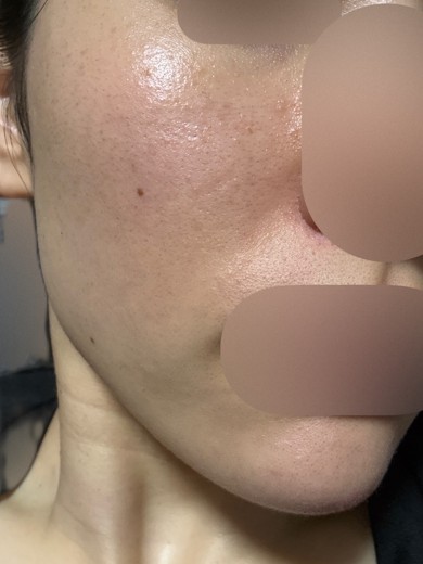 after photo: イオン導入