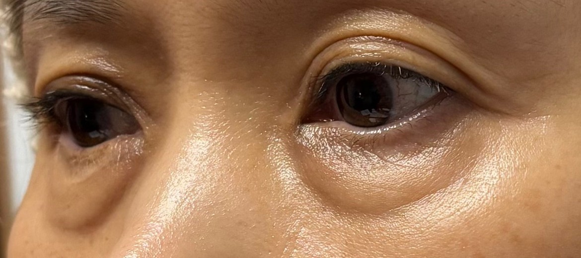 before photo: 눈밑지방재배치