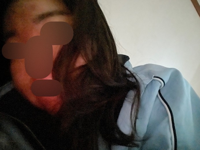 after photo: 여드름주사