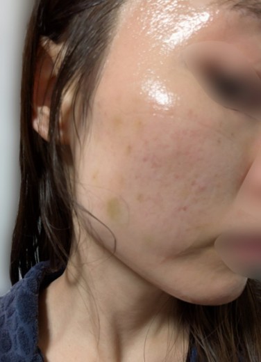 after photo: 脂肪溶解注射(腕), 脂肪溶解注射(太もも)