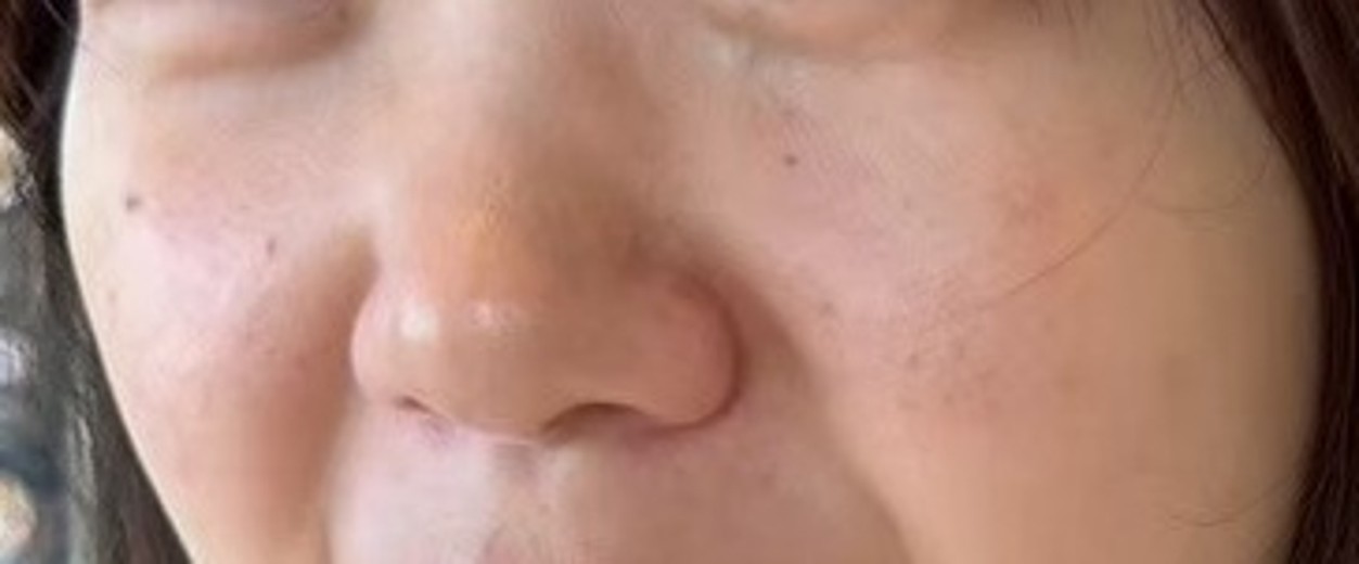 before photo: IPL(光/フォト治療), 診断・検査