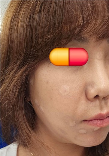 after photo: 점제거시술, V레이저