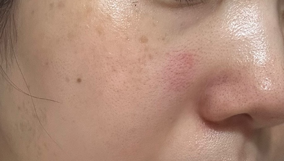 before photo: IPL(光/フォト治療), 診断・検査