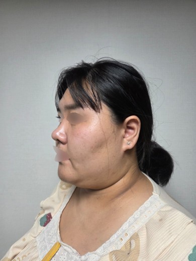 after photo: 비중격만곡증수술, 코끝(보형물)